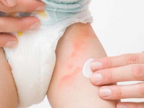 Dermatitis del pañal: Cómo prevenir y tratar esta molesta afección en bebés